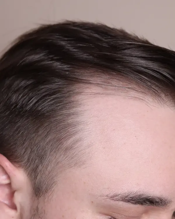 A Estratégia de Precisão: Protocolos Integrados de Nutrientes e Fitoterapia para o Controle da Alopecia.